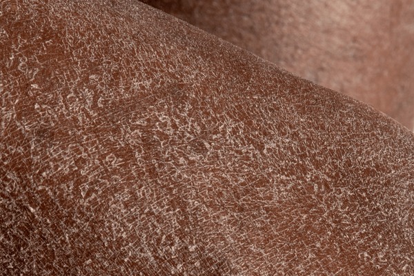 macro-detail-dry-skin-legs-600nw-2221039761